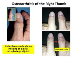 Osteoarthritis of the Right Thumb