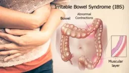 Irritable bowel syndrome (IBS) is defined as a chronic functional bowel disorder in which