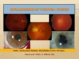 Inflammation   of   THE Uvea -