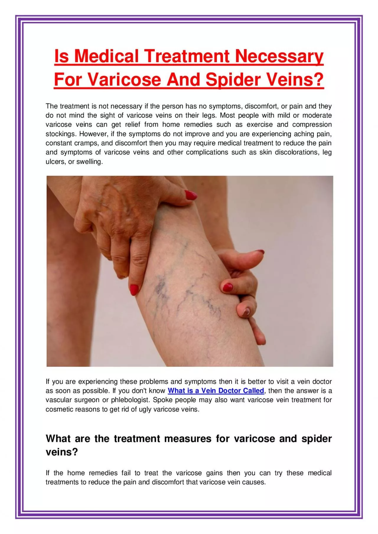Is Medical Treatment Necessary For Varicose And Spider Veins?