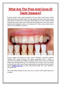 What Are The Pros And Cons Of Teeth Veneers?