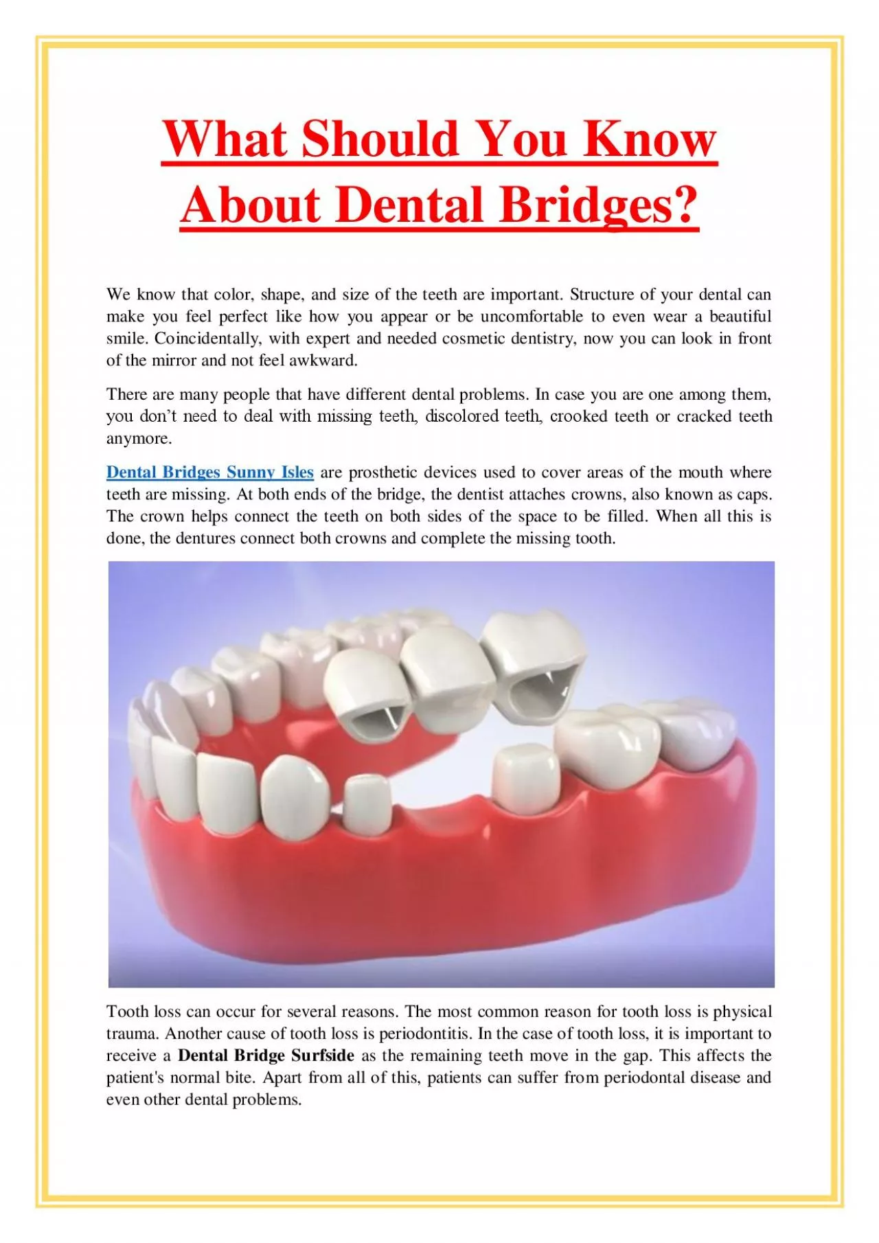 What Should You Know About Dental Bridges?