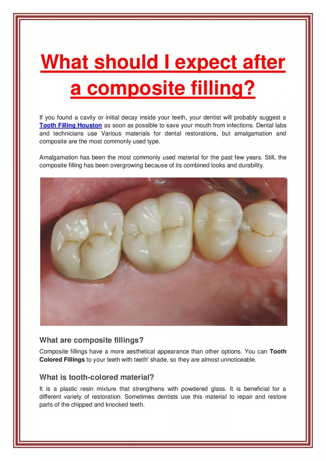 PDF-What should I expect after a composite filling?