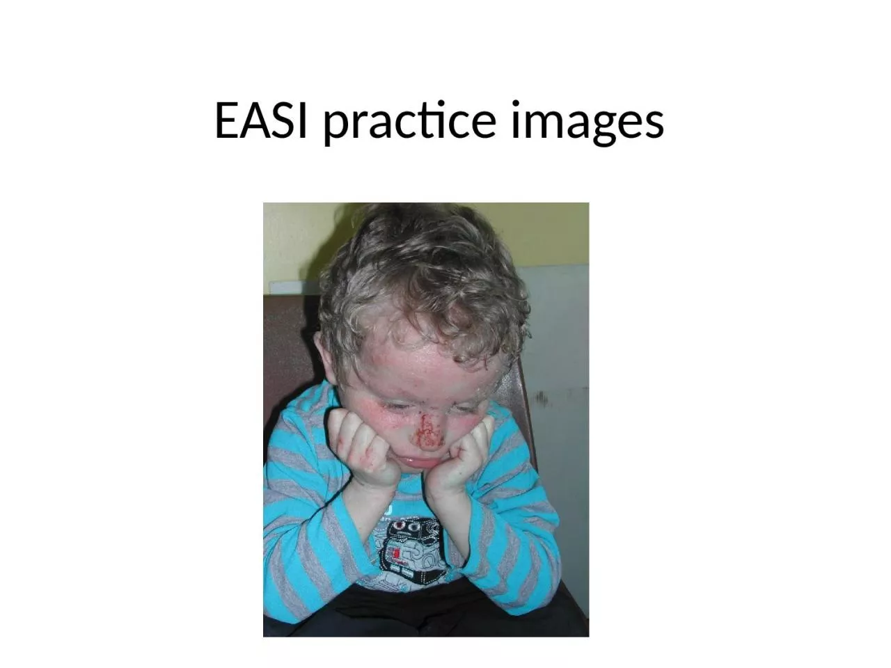 PPT-EASI practice images Start with some body surface area