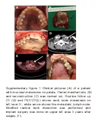 A B C D E F Supplementary figure 1 Clinical pictures (A) of a patient with mucosal melanoma on pala