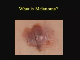 What is Melanoma? Melanoma is the deadliest form of skin cancer