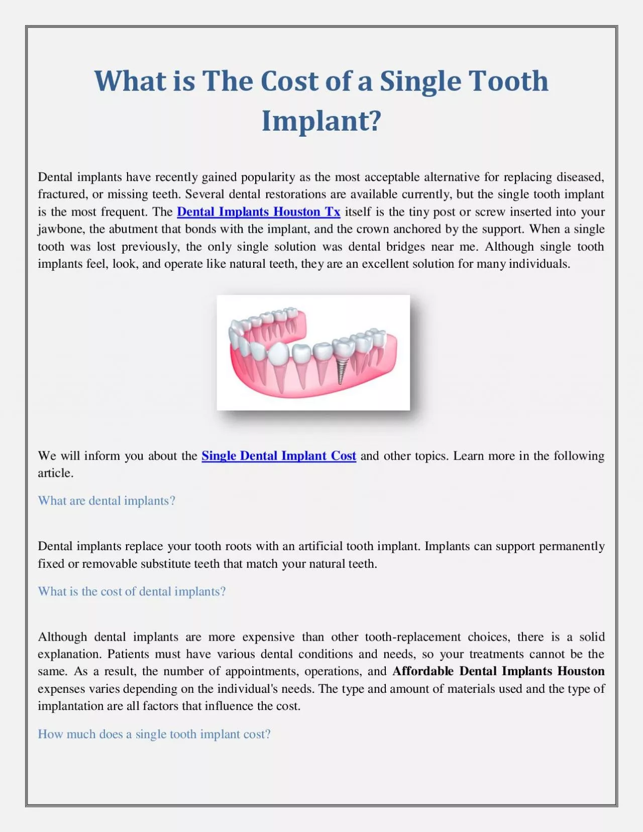 What is The Cost of a Single Tooth Implant?