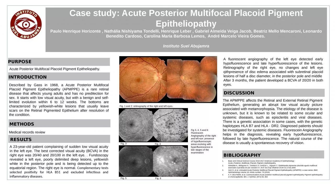 Case  study :  Acute  Posterior Multifocal