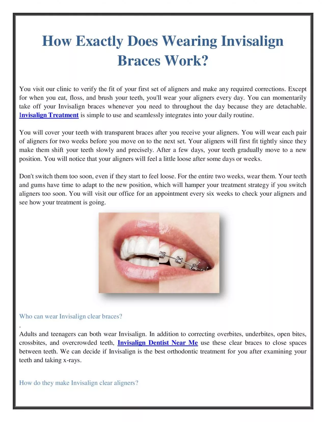 PDF-How Exactly Does Wearing Invisalign Braces Work?