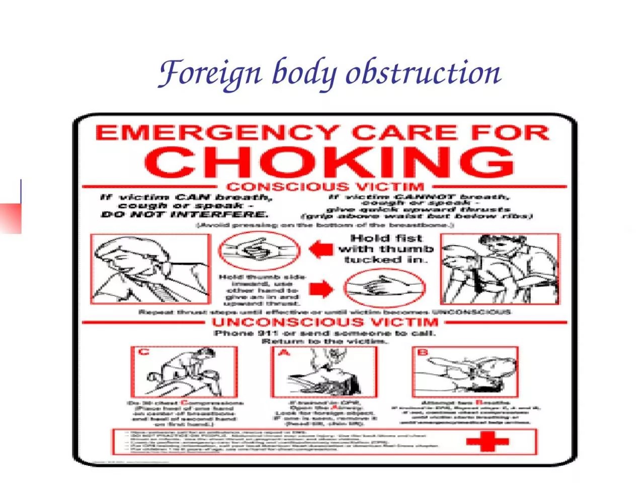 Foreign body obstruction