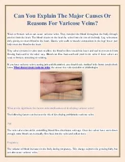 Can You Explain The Major Causes Or Reasons For Varicose Veins?