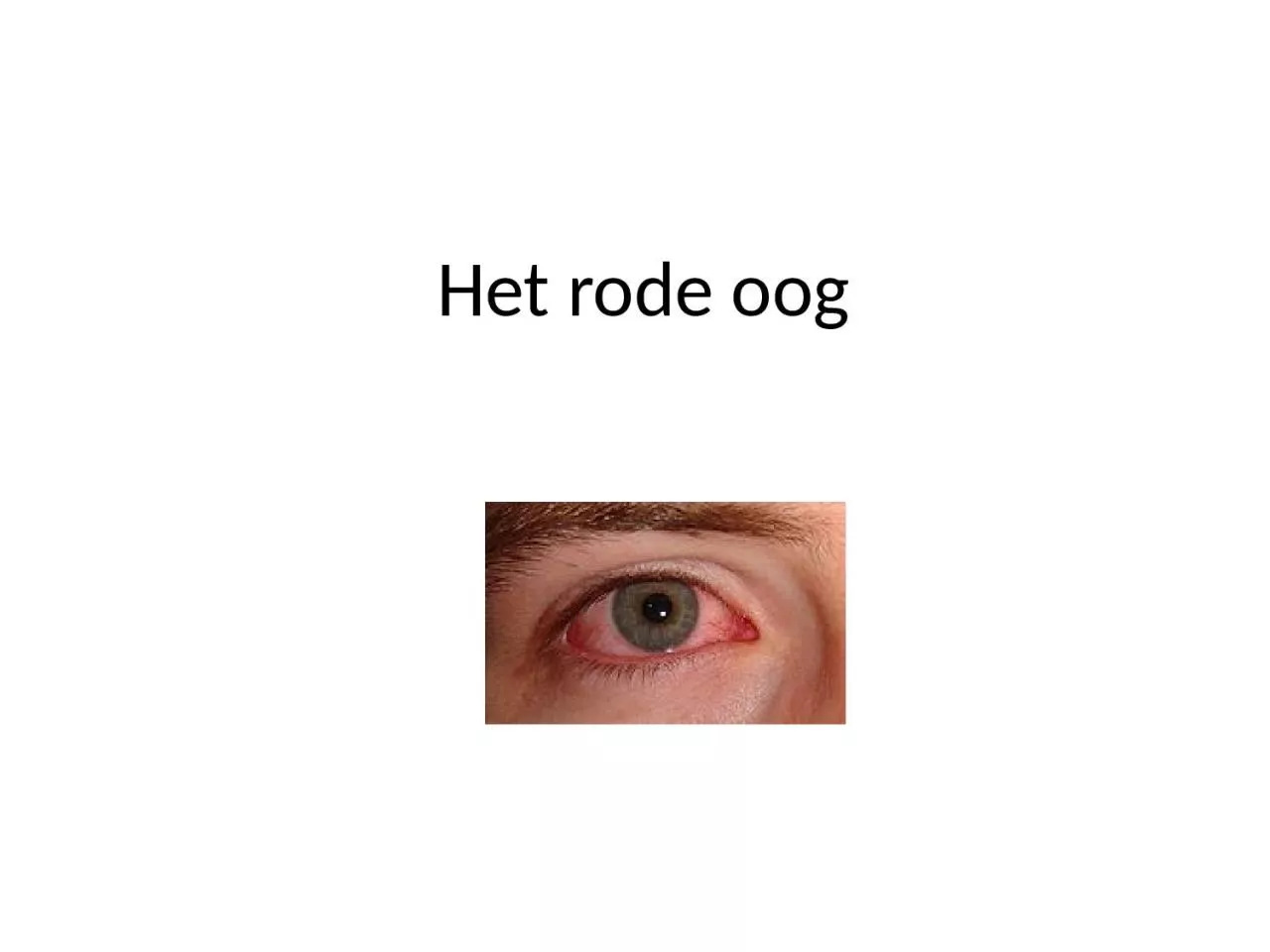 Het rode oog Sclera = buitenste omhulsel oogbol (harde oogrok)