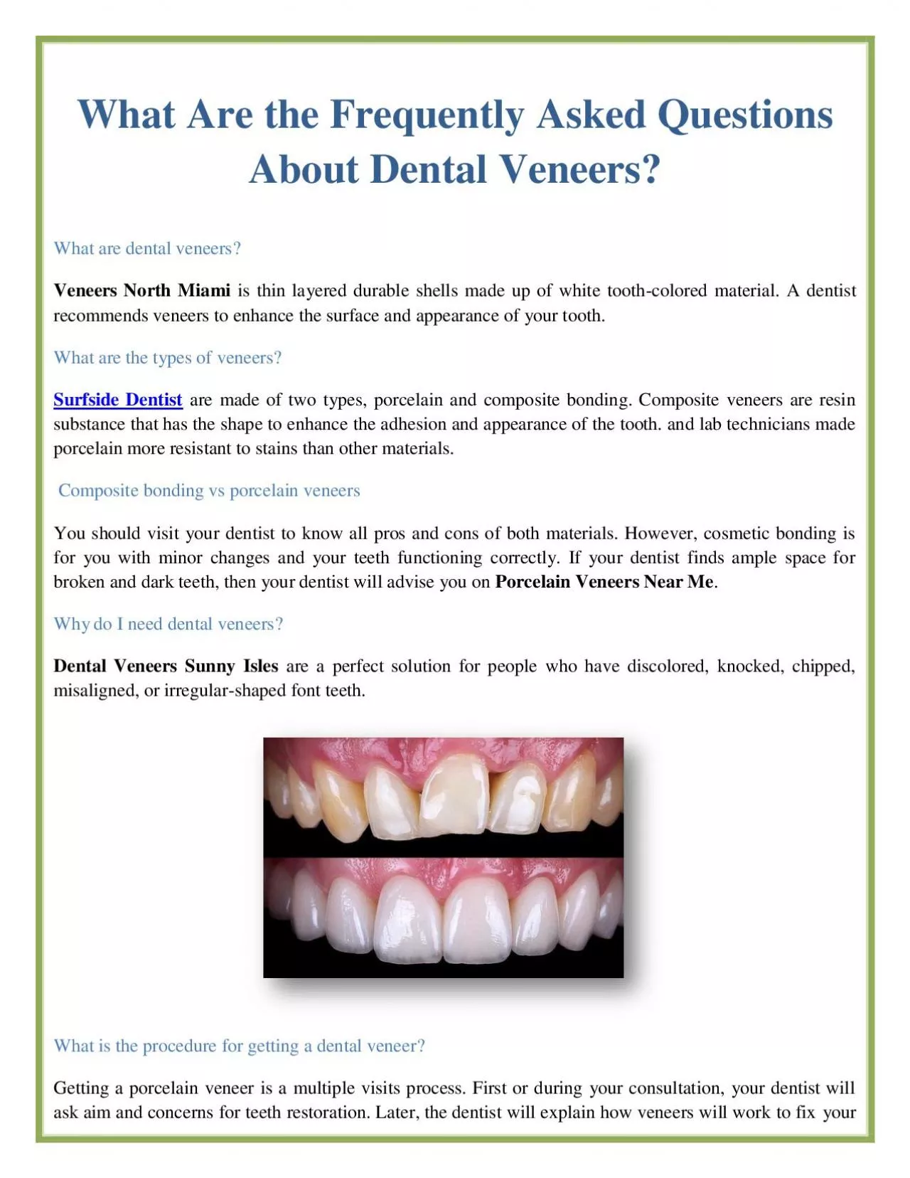 What Are the Frequently Asked Questions About Dental Veneers?