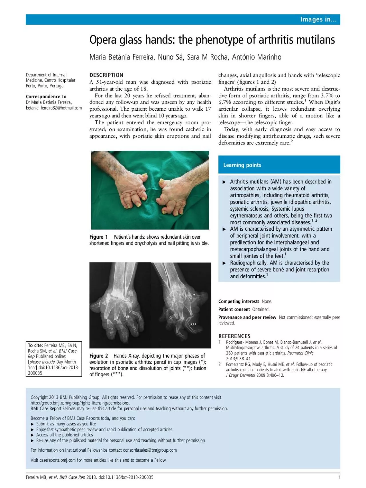 PDF-OperaglasshandsthephenotypeofarthritismutilansMariaBetniaFerreiraNu