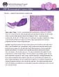 Atypical Hyperplasia Lymphocyte