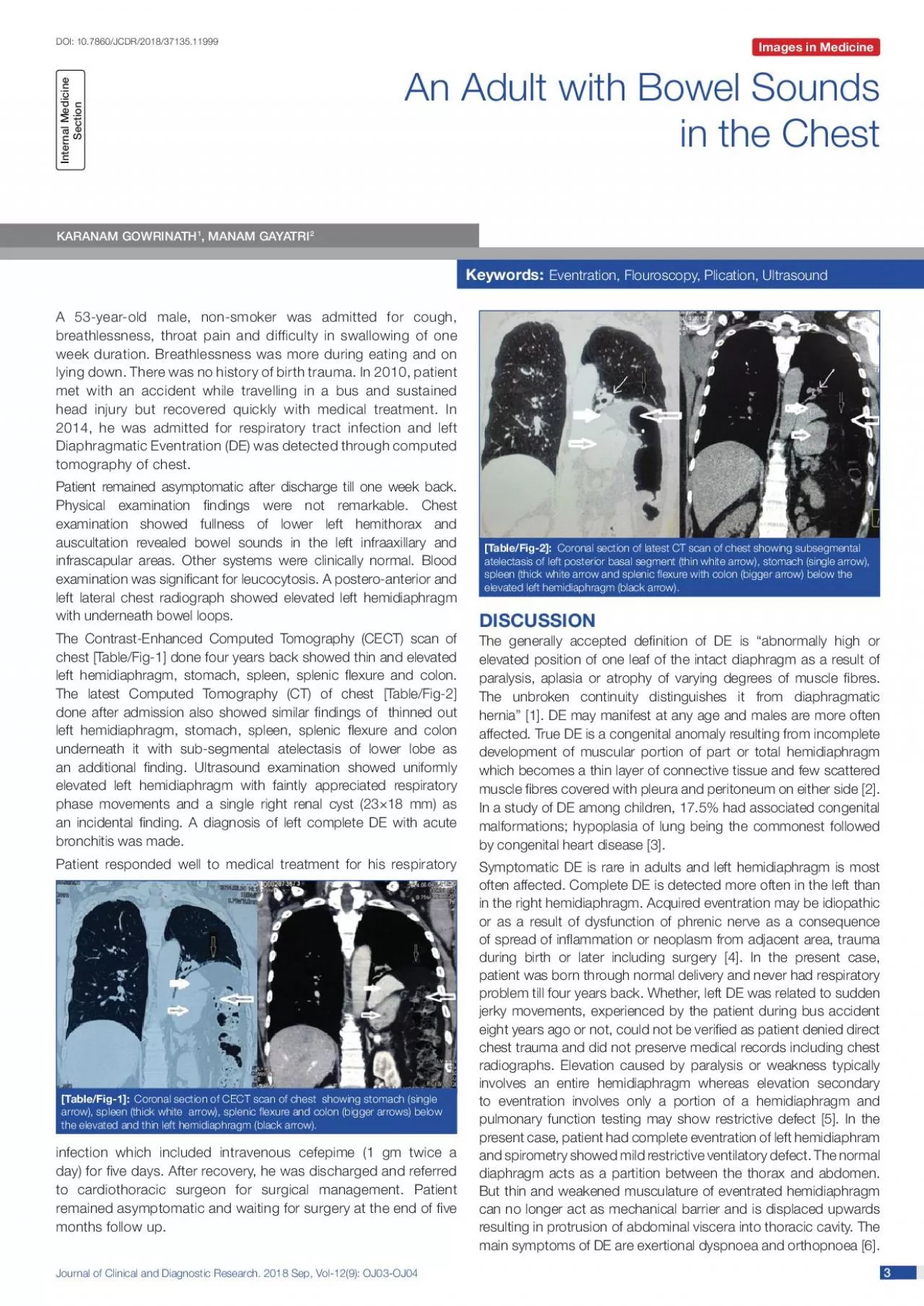 PDF-Journal of Clinical and Diagnostic Research 2018 Sep Vol129 OJ03