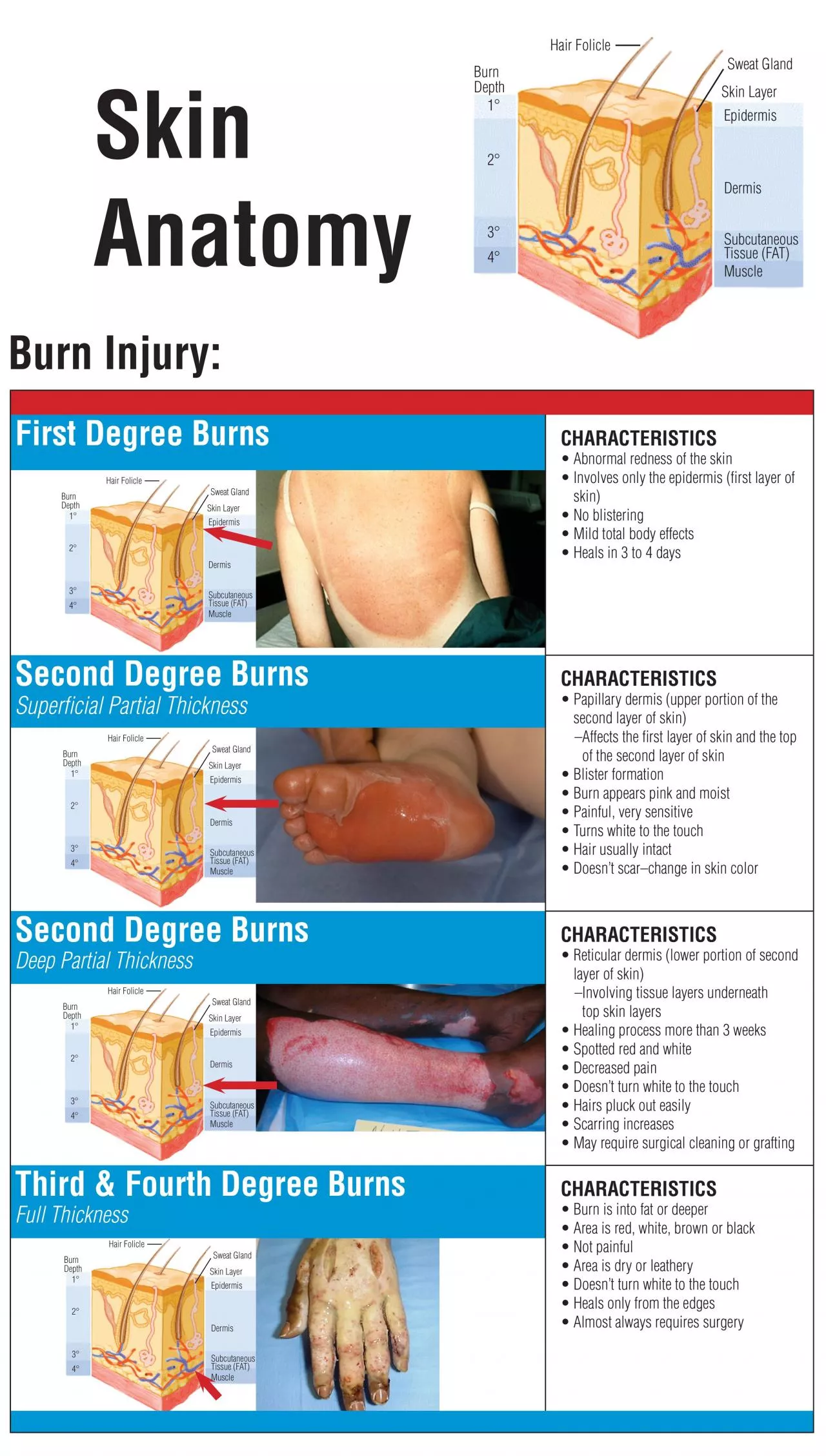 Burn Injury