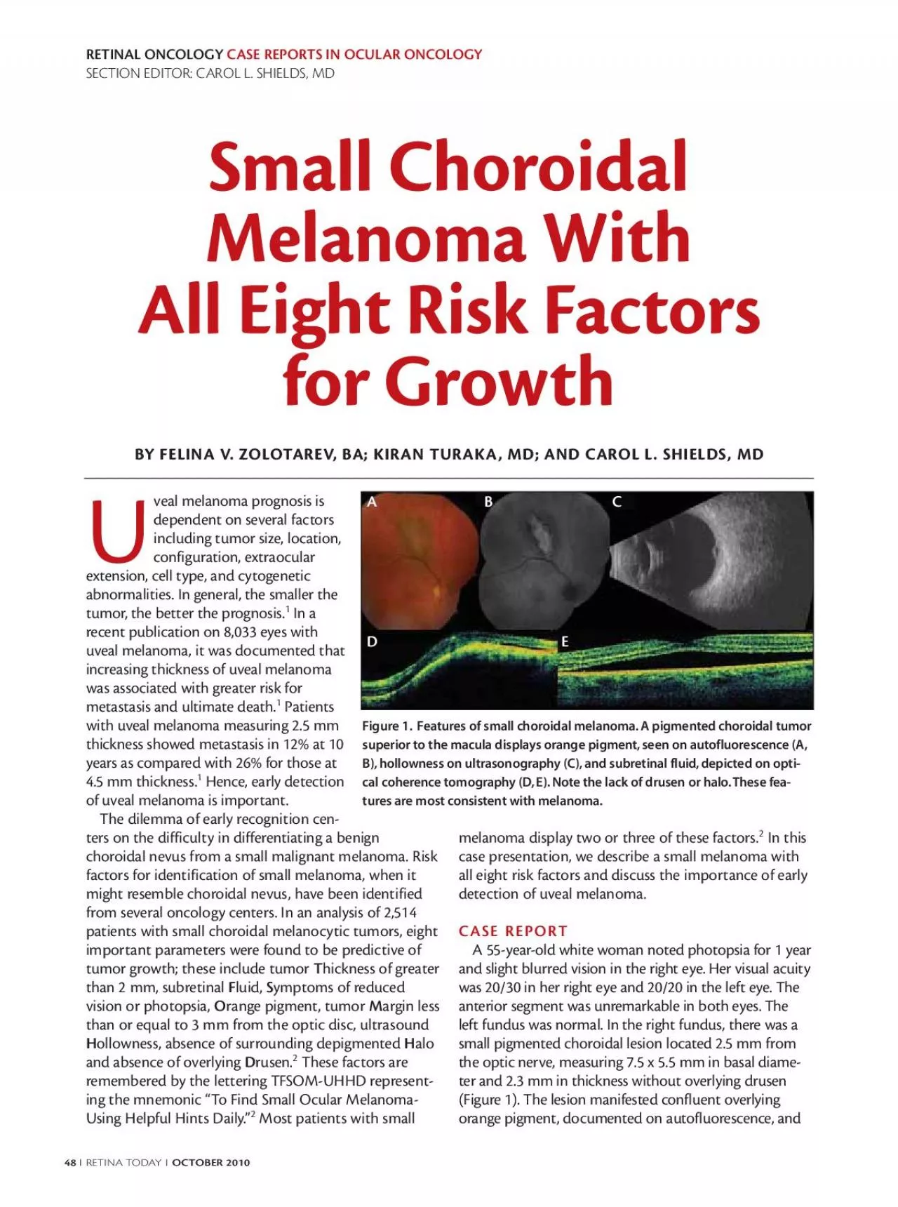 PDF-Small ChoroidalMelanoma With All Eight Risk Factors for Growth