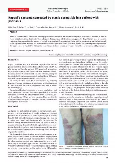 Erythematous squamous psoriatic plaques livid purple Kaposi146