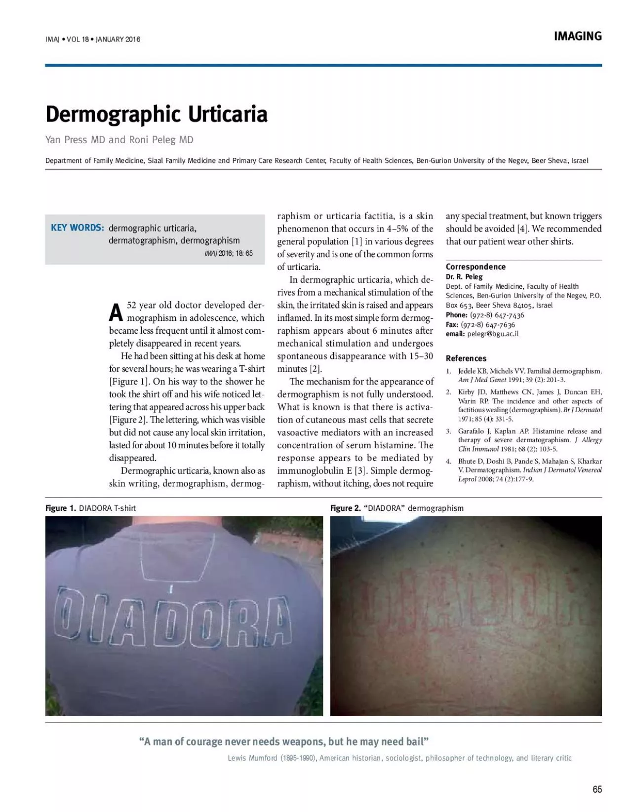 PDF-raphism or urticaria factitia is a skin phenomenon that occurs in 4