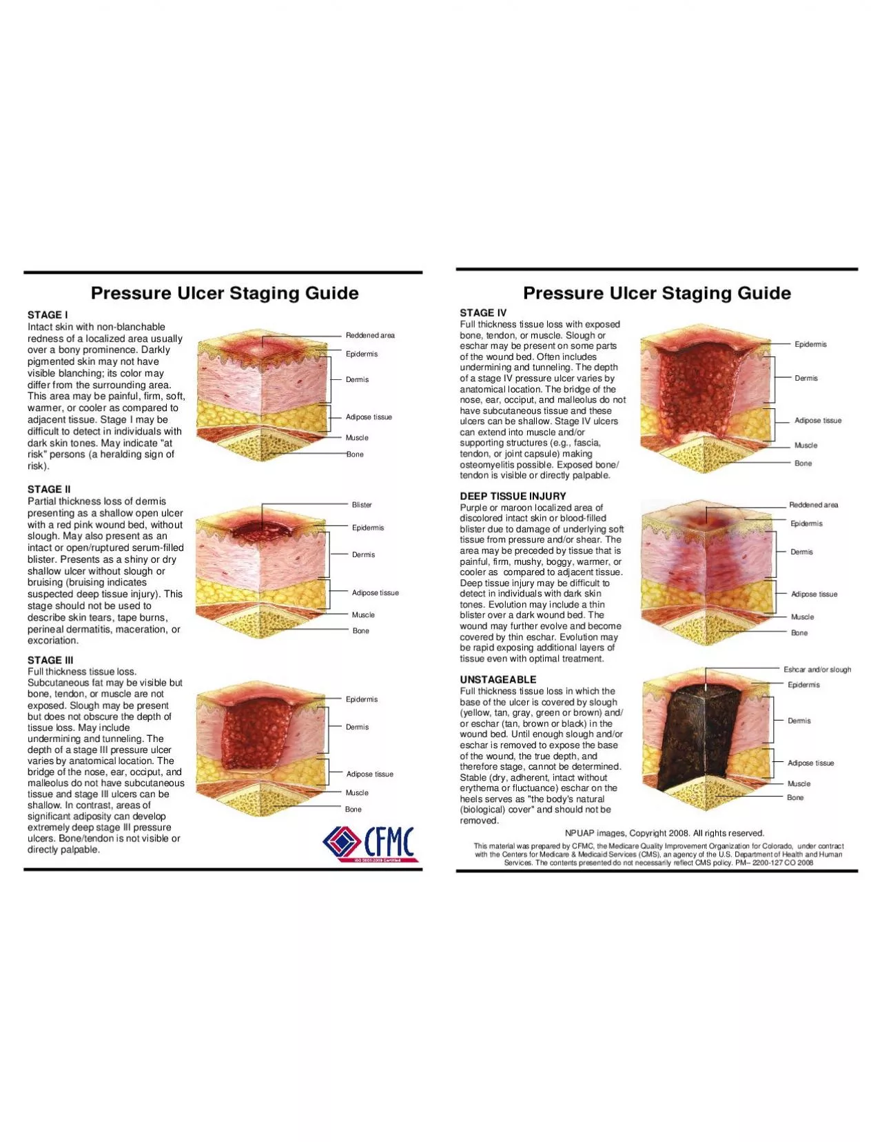 PDF-STAGE IIIFull thickness tissue loss Subcutaneous fat may be