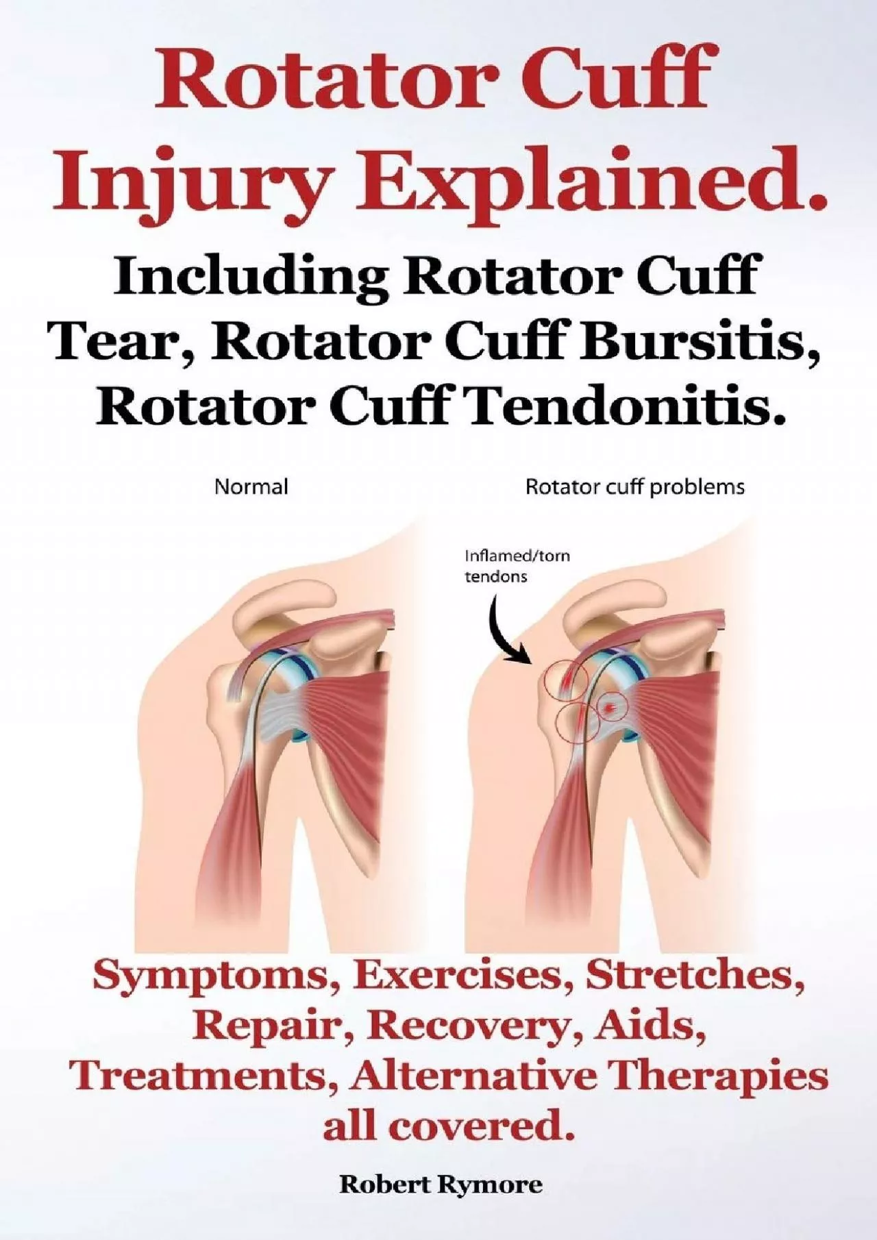 PDF-(DOWNLOAD)-Rotator Cuff Injury Explained. Including Rotator Cuff Tear, Rotator Cuff Bursitis,