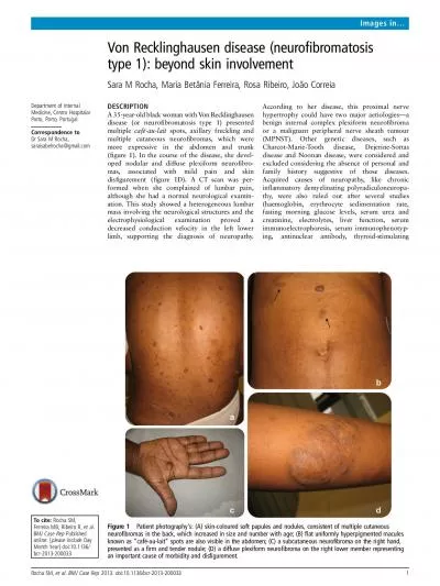 VonRecklinghausendiseaseneurobromatosistype1beyondskininvolvementSa