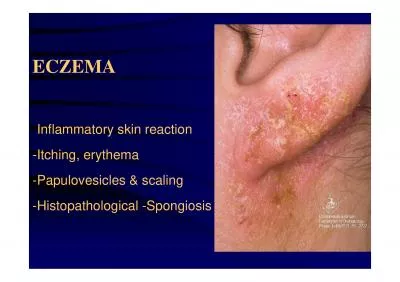 Inflammatory skin reaction Itching erythema Papulovesicles  scalin