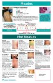 MeaslesNot MeaslesKoplik146s SpotsViral enanthem of measles typical