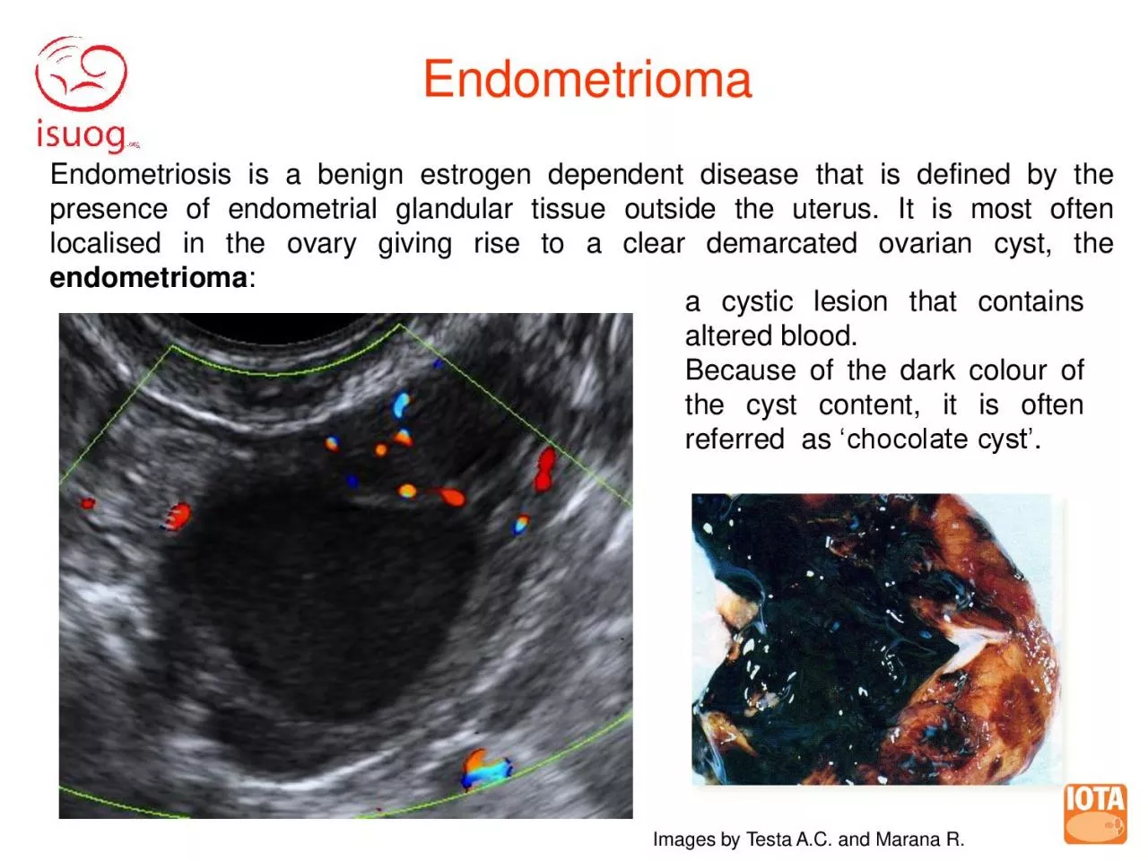 PDF-Endometrioma