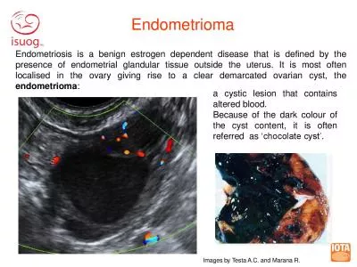 Endometrioma