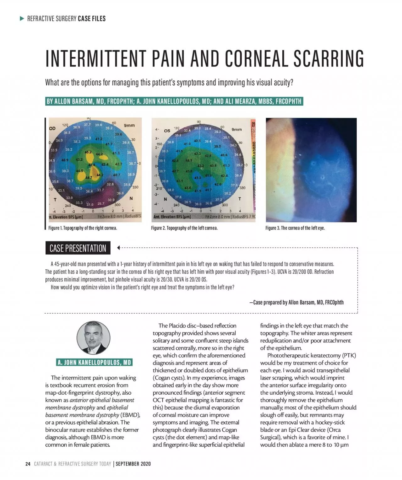 PDF-REFRACTIVE SURGERY