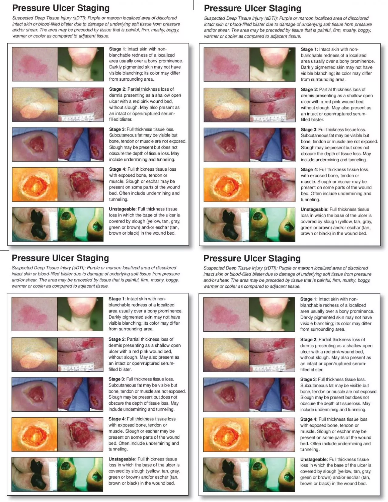 PDF-Full thickness tissue loss Subcutaneous fat may be visible but bone