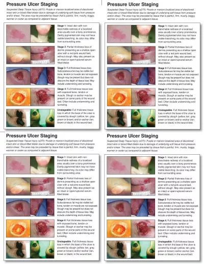 Full thickness tissue loss Subcutaneous fat may be visible but bone