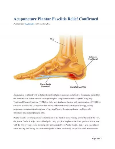 Acupuncture Plantar Fasciitis Relief Confirmed