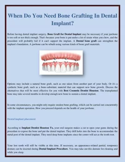 When Do You Need Bone Grafting In Dental Implant?