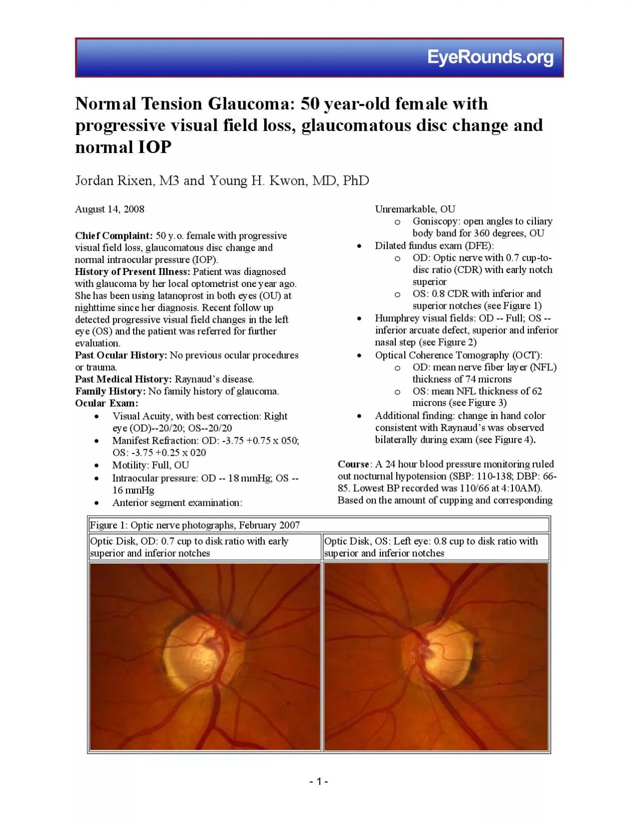 PDF-Normal Tension Glaucoma 50 yearold female with progressive visual fi