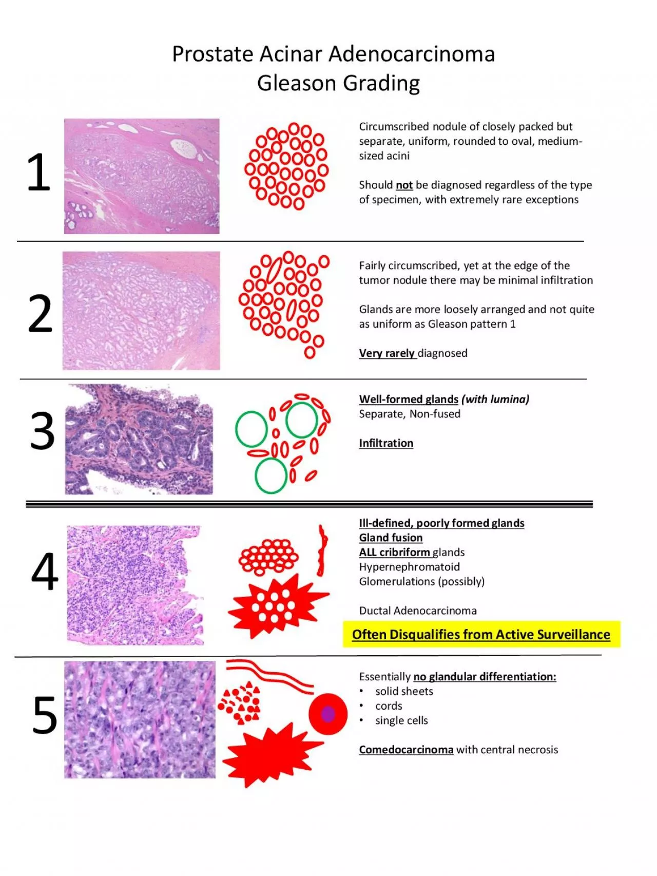 PDF-Adenocarcinoma