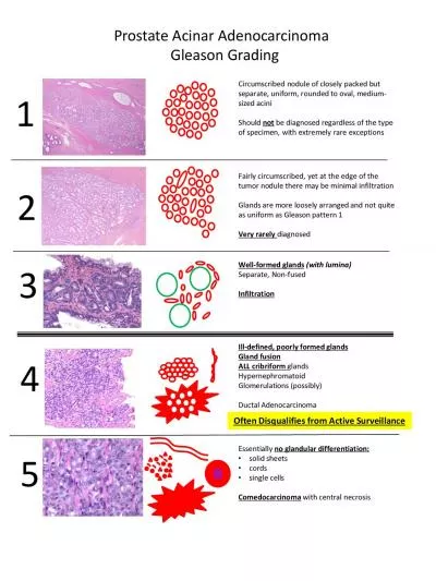 Adenocarcinoma