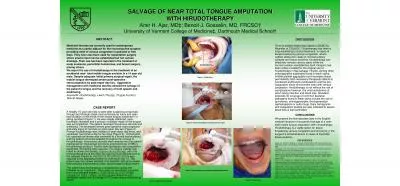 SALVAGE OF NEAR TOTAL TONGUE AMPUTATION SALVAGE OF NEAR TOTAL TONGUE A