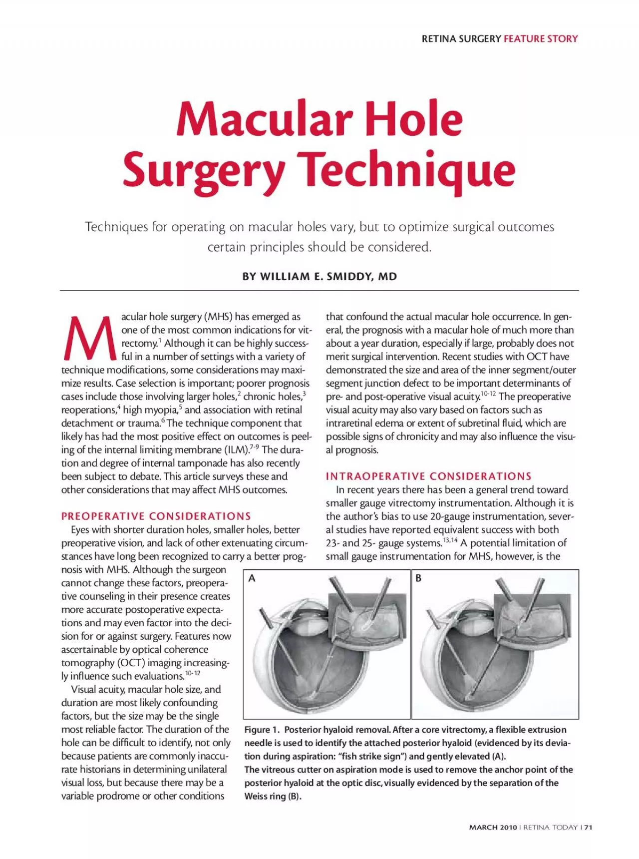 PDF-RETINA SURGERY FEATURE STORY