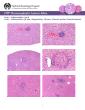 PDF-Inflammation focal