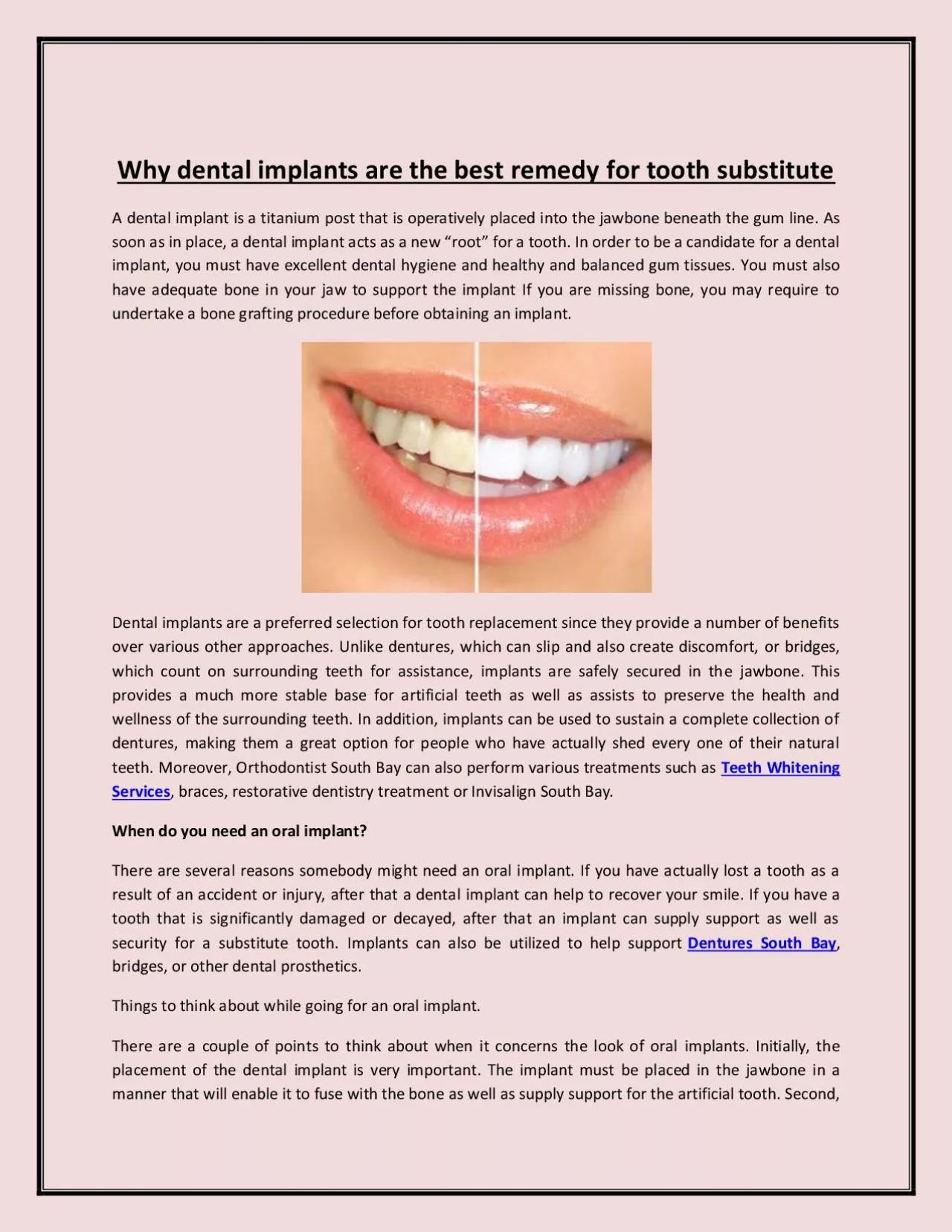 PDF-Why dental implants are the best remedy for tooth substitute