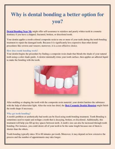 Why is dental bonding a better option for you?