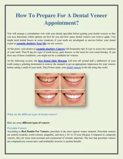 How To Prepare For A Dental Veneer Appointment?