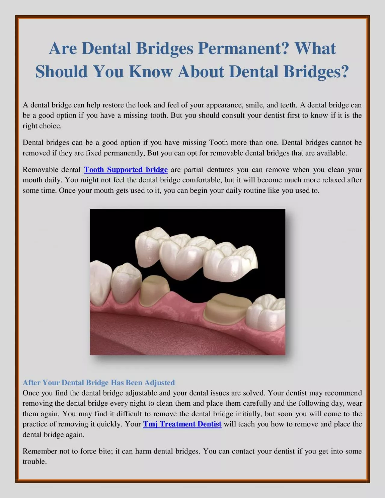 Are Dental Bridges Permanent? What Should You Know About Dental Bridges?