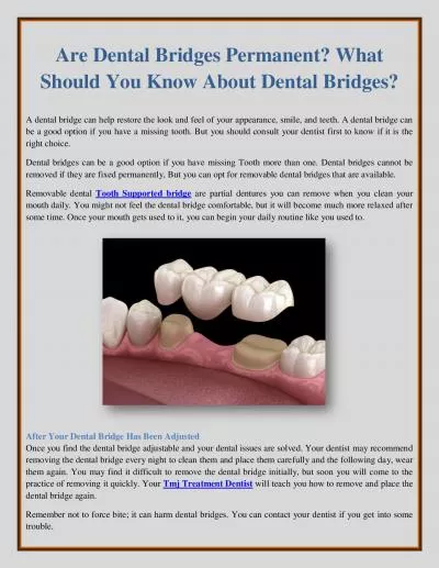 Are Dental Bridges Permanent? What Should You Know About Dental Bridges?