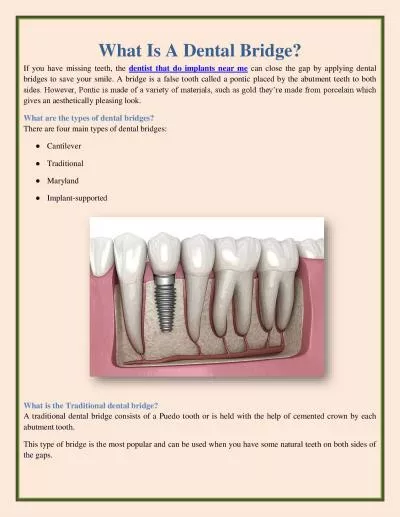 What Is A Dental Bridge