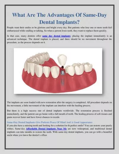 What Are The Advantages Of Same-Day Dental Implants?