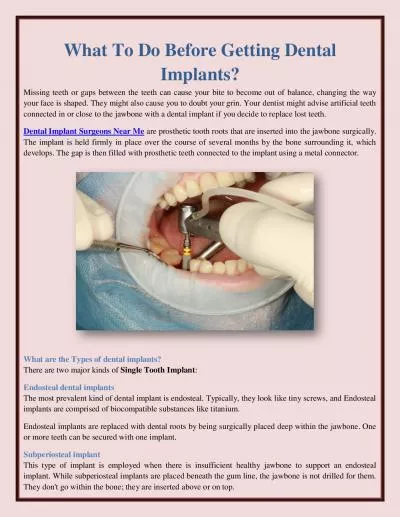 What To Do Before Getting Dental Implants?